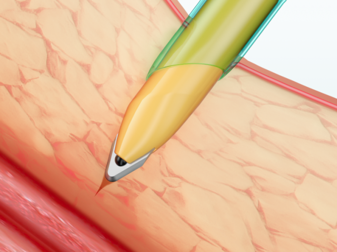 Cánula disponible de Trocar de los instrumentos Laparoscopic con la cuchilla 1