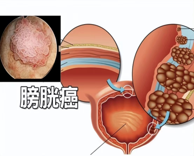 últimas noticias de la compañía sobre Diagnóstico clínico y cuidado fisiológico del cáncer de vejiga.  0